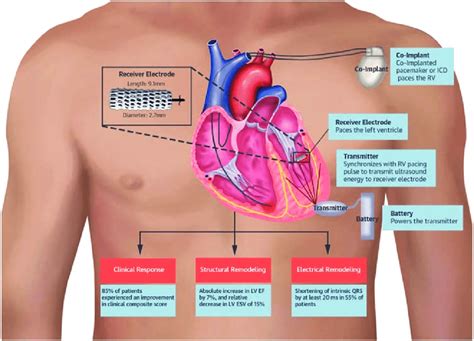 lv pacemaker lead placement|left ventricular implantation.